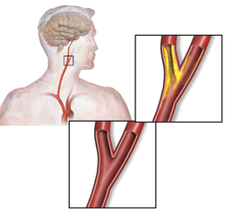 Rendere le arterie più elastiche? Uno studio ci dice come fare